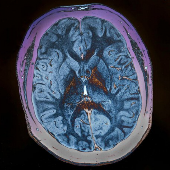Image of brain scan on computer screen